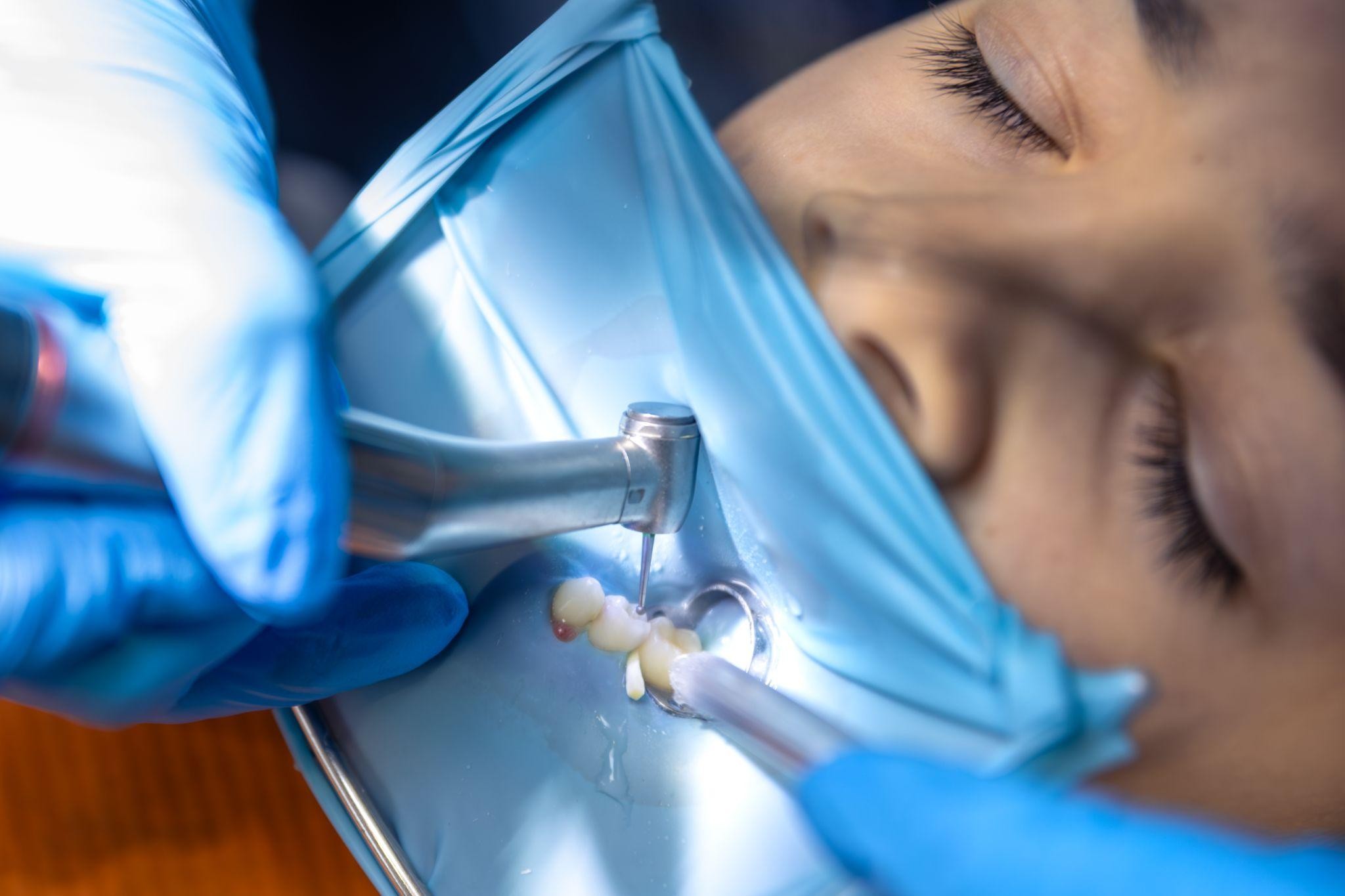 Dentist in Sarasota, FL, performing a restorative dentistry procedure with a dental drill and rubber dam to protect the tooth.