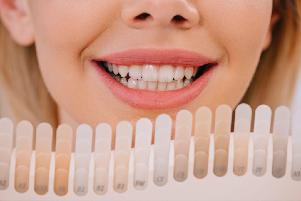 A close-up of a smiling woman holding a teeth color chart against her white teeth, showcasing the process of choosing the perfect shade for dental veneers. Porcelain veneers enhance both the color and appearance of natural teeth.